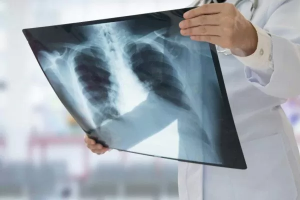 Fungsi Paru Paru Pasien turun setelah sembuh dari corona