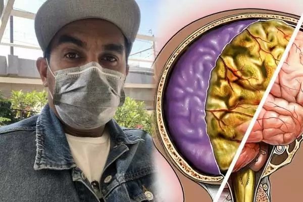 Apa itu Meningitis