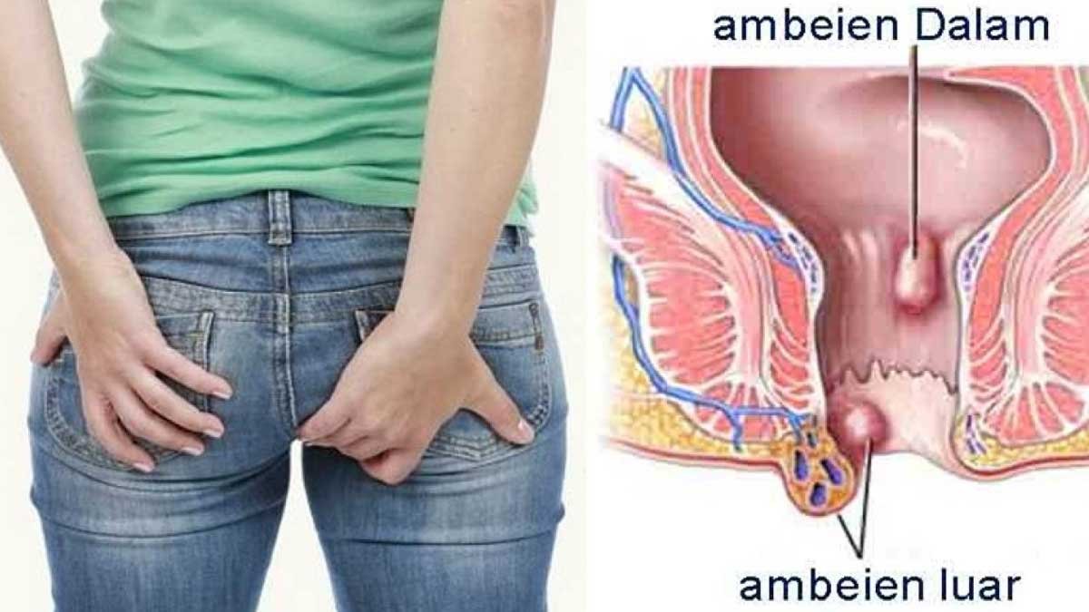 Gejala Ambeien