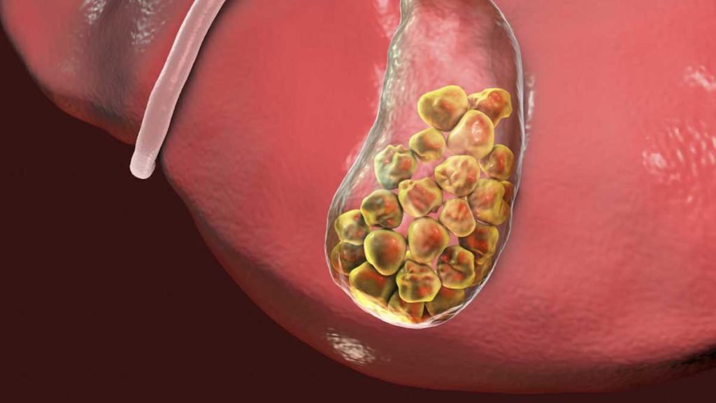 Gejala Dan Penyebab Batu Empedu