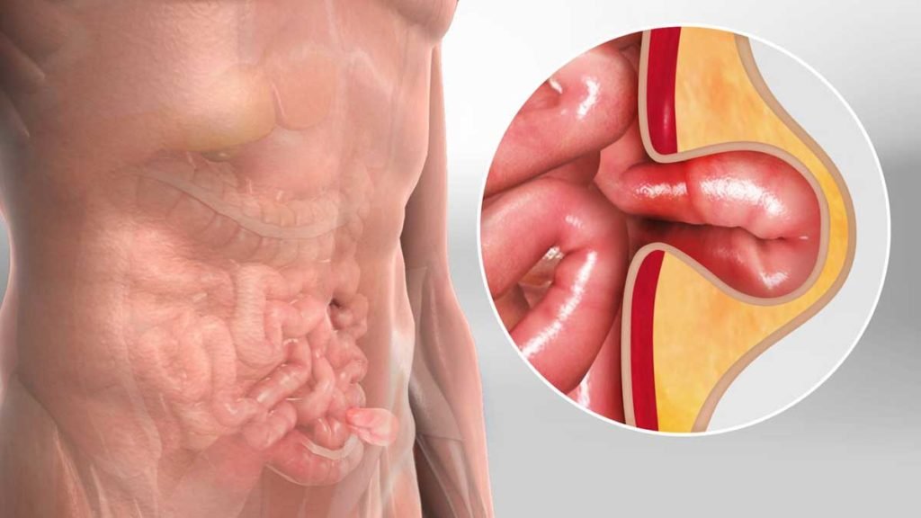 Pengobatan Hernia Tanpa Operasi