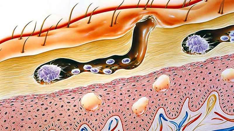 Telur Tungau Scabies atau Kudis