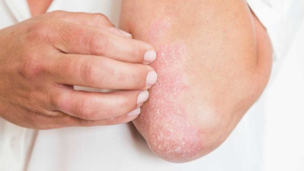 Penyakit Kulit Psoriasis