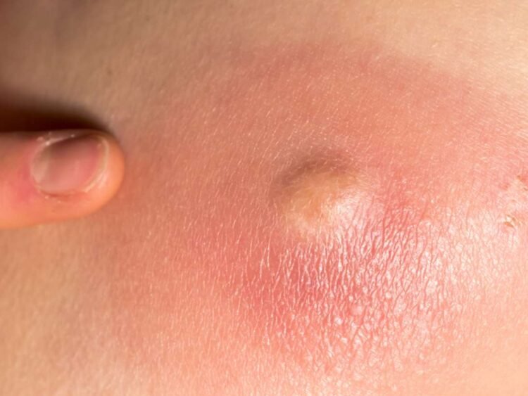 Makanan penyebab bisul