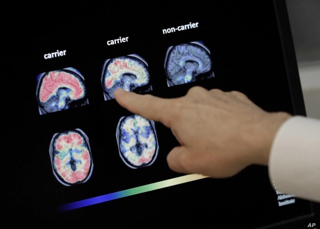 7 Komplikasi Penyakit Alzheimer