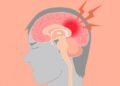 Stroke Hemoragik: Gejala, Penyebab, Pengobatan, dan Pencegahan