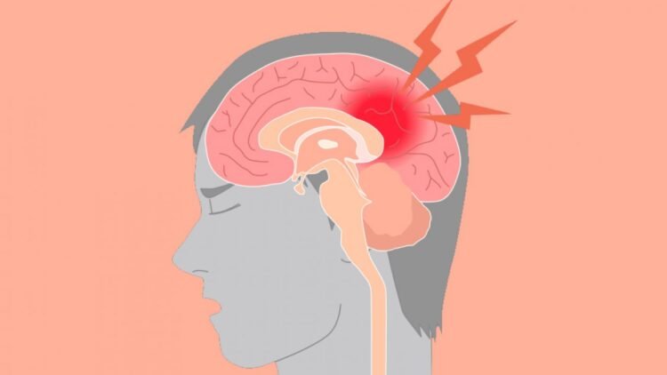 Stroke Hemoragik: Gejala, Penyebab, Pengobatan, dan Pencegahan