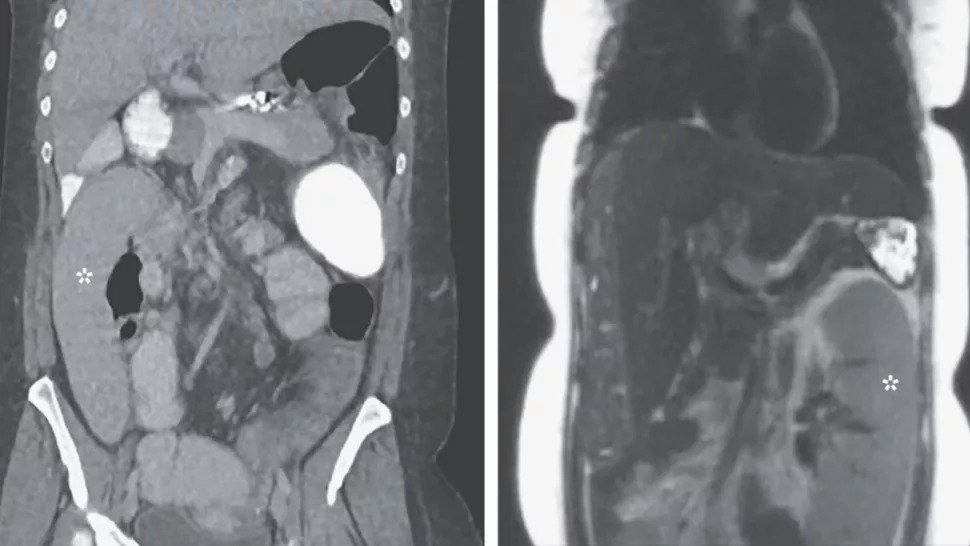 Organ limpa bermigrasi
