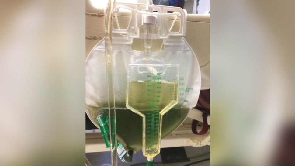 Urine berwarna hijau