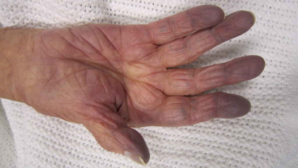 Sianosis