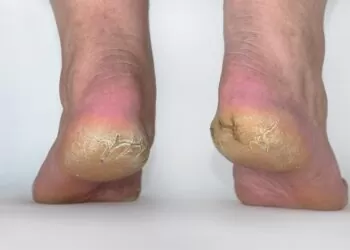 Cara Mengatasi Tumit Kaki Pecah-Pecah Secara Alami