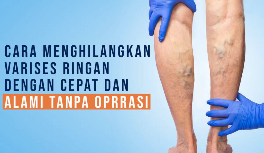 Cara menghilangkan varises dengan cepat dan alami tanpa operasi