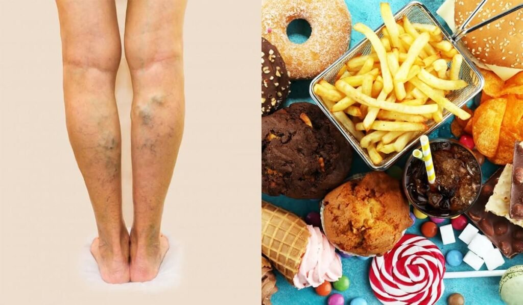 Makanan pantangan bagi penderita varises
