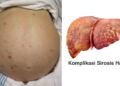 Komplikasi sirosis hati