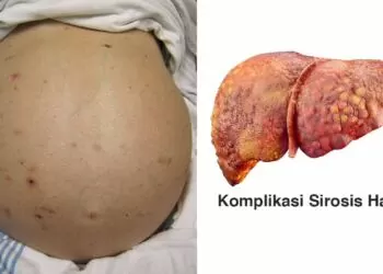 Komplikasi sirosis hati